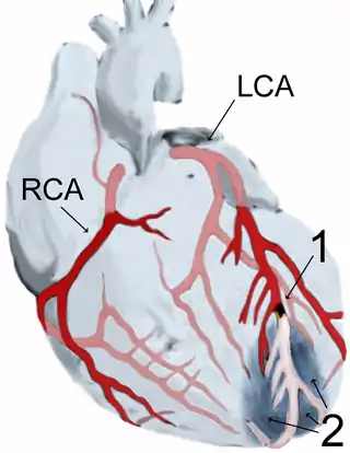 Diagrama de un infarto de miocardio.