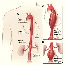 Aneurisma de aorta