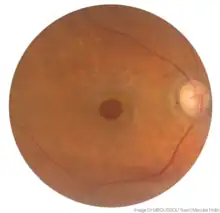 A macular Hole