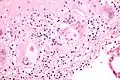 Micrografía de cuerpos de asteroides en sarcoidosis pulmonar. Tinción con hematoxilina eosina.