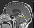 1. Astrocitoma de bajo grado del mesencéfalo (lámina tecti), resonancia magnética sagital ponderada en T1 después de la administración de medio de contraste: el tumor está marcado con una flecha. Los espacios del LCR frente al tumor se expanden debido a la hidrocefalia interna inducida por compresión..