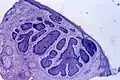 Carcinoma de células basales bajo el microscopio