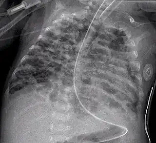 Una radiografía torácica mostrando displasia broncopulmonar.