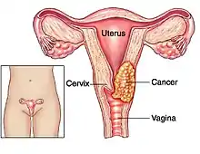 Cervical cancer