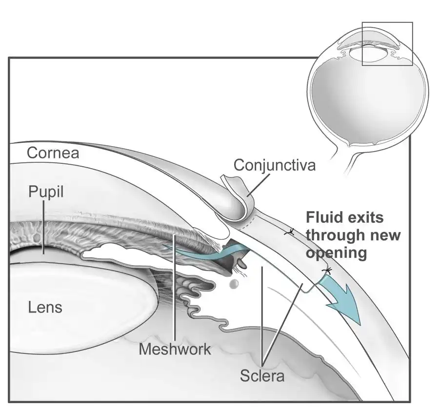 Conventional surgery to treat glaucoma EDA11