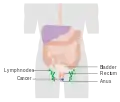 Etapa 2 del cáncer anal