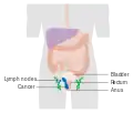 Etapa 3 del cáncer anal