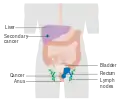 Etapa 4 del cáncer anal