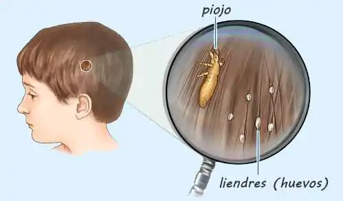 Diferencia entre piojos y liendres