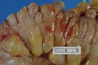 Intestino grueso (colon sigmoide) que muestra múltiples divertículos: observe cómo aparecen los divertículos a ambos lados del haz de músculos longitudinales (tenio).