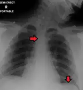 Placa portátil (o sea, anteroposterior) mostrando tubo endotraqueal y tubo nasogástrico, ambos en correcta posición.