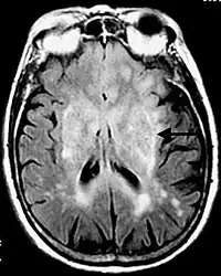 Imagen de RM en secuencia FLAIR que demuestra infiltración relacionada con tumor que involucra núcleos lenticulares (Flecha).