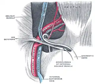 Cordón espermático en el conducto inguinal.