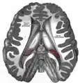 Disección que muestra los ventrículos del cerebro.