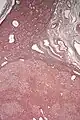 Micrografía de adenoma hepático. Impregnación argéntica.