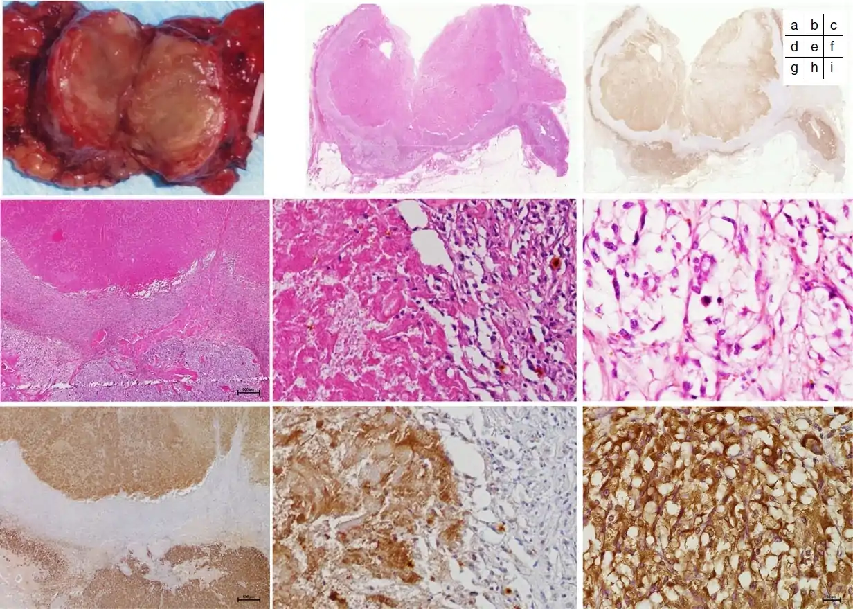 Histopathology_of_a_pheochromocytoma_with_coagulative_necrosis,_with_immunostaining