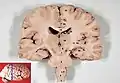 Corte frontal de un cerebro humano.