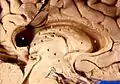 Hemisferio cerebral izquierdo humano diseccionado en vista media sagital. El número 11 corresponde con la estría terminal