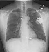 Placa de tórax tomada después de colocar un desfibrilador automático implantable; muestra el generador del aparato en el tórax superior izquierdo y la derivación (electrodo) del aparato en la cavidad del ventrículo derecho. Nótese ambos resortes radiopacos a lo largo de la derivación del aparato.