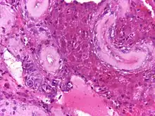 Imagen de una micrografía de tejido testicular mostrando hialinización y fibrosis de los túbulos seminíferos así como células de Leyding prominentes. Tinción de hematoxilina y eosina para contraste y aprenciación de los compartimentos celulares.