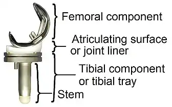 Componentes principales de una prótesis de rodilla.