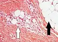 Lipoblastos (flecha blanca) y adipocitos (flecha negra), en un caso de lipoblastoma