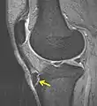 MBq Osgood-Schlatter, flecha mostrando la enfermedad