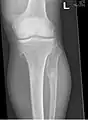 múltiples osteocondromas alrededor de la rodilla