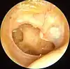 Otitis media crónica mesotimpánica