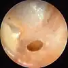 Otitis media crónica mesotimpánica