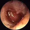 Otitis media crónica mesotimpánica