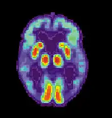 Tomografía computarizada del cerebro con EA - Imagen cortesía del Instituto Nacional de Envejecimiento de EE. UU. Centro de Referencia y Educación sobre la Enfermedad de Alzheimer