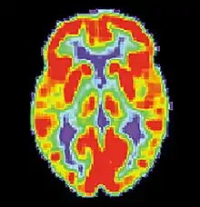 Tomografía por emisión de positrones (PET, por sus siglas en inglés) de un cerebro sano. Imagen cortesía del Instituto Nacional de Envejecimiento de EE. UU. (EE. UU.). Centro de educación y derivación para la enfermedad de Alzheimer.