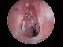  Papilomatosis Laríngea