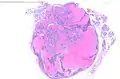 Cistoadenolinfoma (tumor de Warthin) de una parótida.