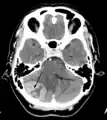 Tumor de la fosa posterior que provoca efecto de masa y desplazamiento del cuarto ventrículo.