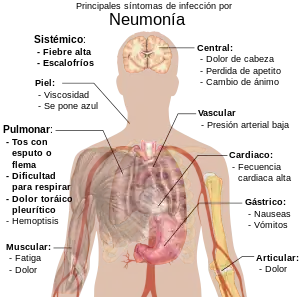 Principales síntomas de la neumonía infecciosa.