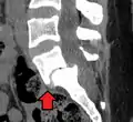 Anterolistesis L5/S1