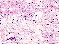 Schwannoma subcutaneo Antoni B