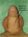 Vena dorsal superficial en el pene flácido.