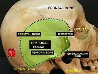 Visión lateral del cráneo, en la que se observa la fosa temporal (en inglés, temporal fossa), la cual incluye al hueso parietal, además del hueso frontal y hueso occipital.