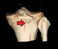 Reconstrucción 3D de una imagen CT de una fractura de meseta tibial