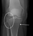 Una fractura de meseta tibial vista con rayos-X