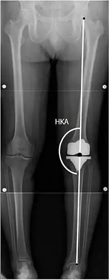 CRT: Ángulo cadera-rodilla-tobillo, que idealmente está entre 3° en varum y 3° en valgum desde un ángulo recto.