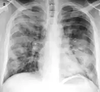 Placa torácica mostrando consolidación pulmonar multifocal y bilateral, característica de la bronconeumonía.