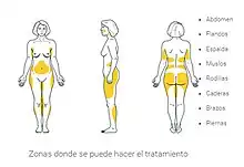 zonas lipoescultura