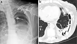 Radiografía de tórax (izquierda) y tomografía computarizada (derecha) que muestran fibrotórax.