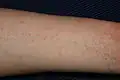 Escabiosis en el brazo