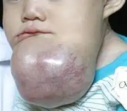 Un niño con un ameloblastoma masivo de la mandíbula.