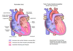 Miocardiopatía de takotsubo